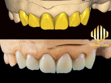 Servicio de Cad Dental: UPPER ANTERIOR CASE