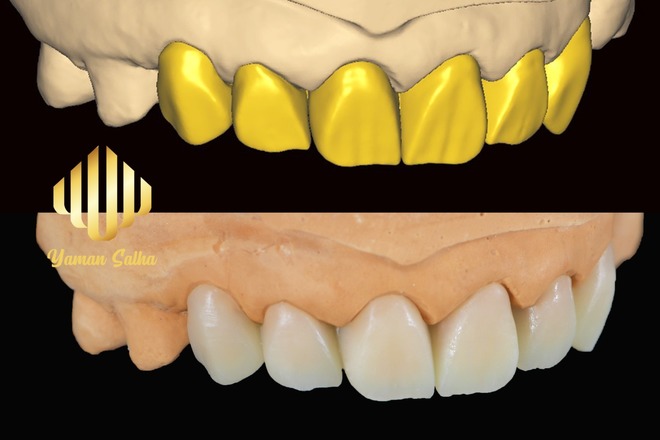 UPPER ANTERIOR CASE