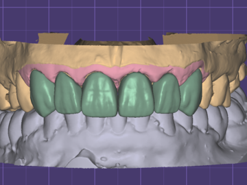 Servicio de Cad Dental: Wax up