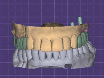 Dental Cad-Service: Implant Crown and bridge