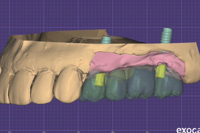 Crown and bridge - CadCam Masters