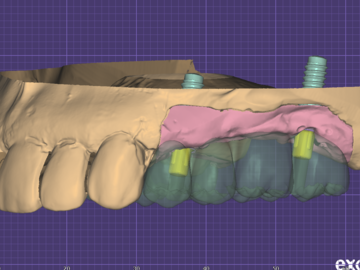 Dental Cad-Service: Crown and bridge