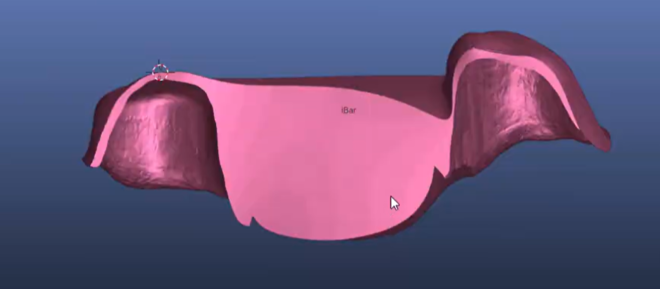 splitting bridges into bar and shell (implant or tooth supported)