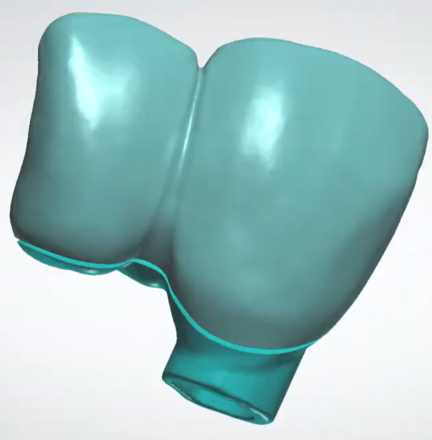 splitting bridges into bar and shell (implant or tooth supported)
