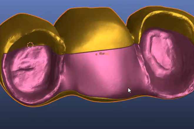 splitting bridges into bar and shell (implant or tooth supported)