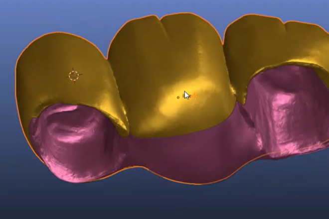splitting bridges into bar and shell (implant or tooth supported)