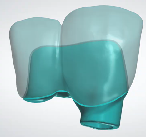 splitting bridges into bar and shell (implant or tooth supported)