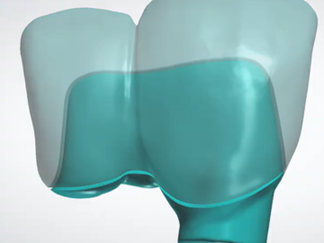Serviço de Cad Dental: splitting bridges into bar and shell (implant or tooth supported)