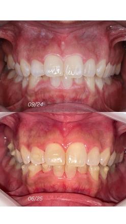  Digital Orthodontic Planning/Planejamento Ortodôntico Digital