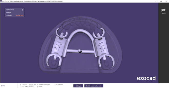 Metal framework for partial denture