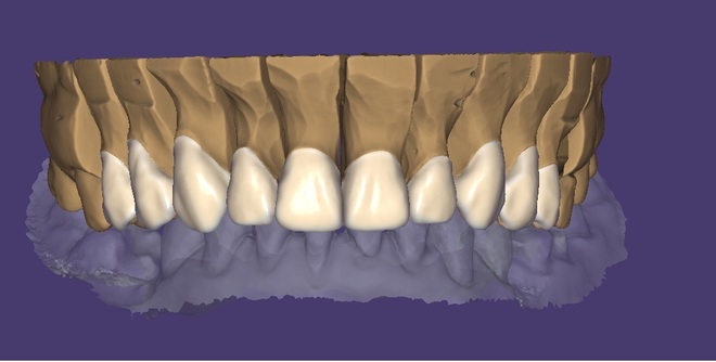 Crowns, Veneers, Bridges - CadCam Masters