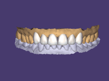 Dental Cad Service: Design services for wax ups