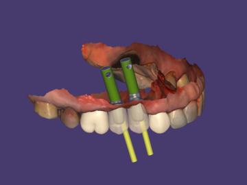 Dental Cad-Service: Implant based crowns and bridges