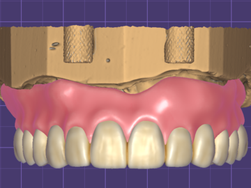 Serviço de Cad Dental: Full Denture