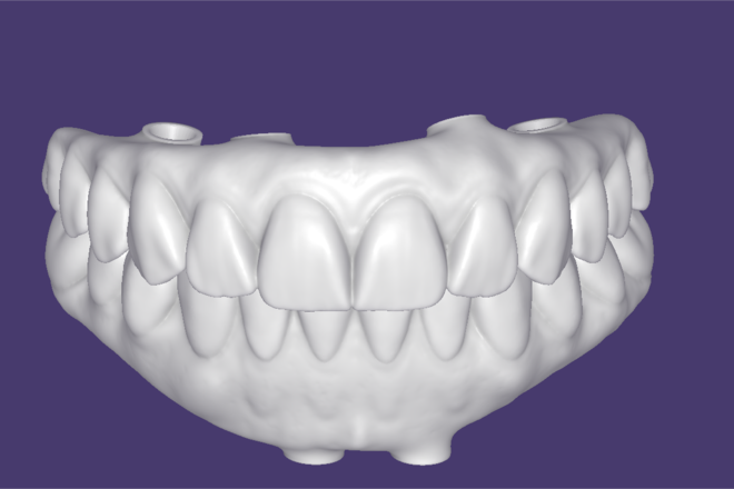All on X - Full arch over implants