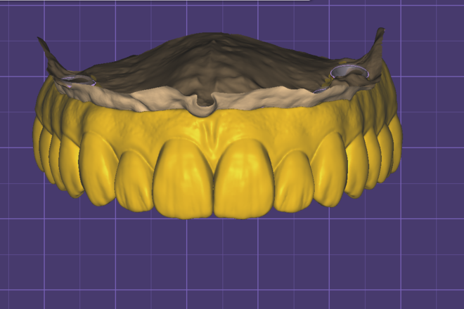 All on X - Full arch over implants