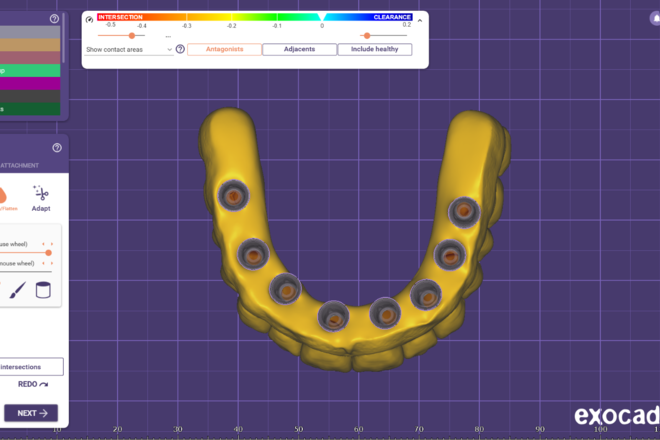 All on X - Full arch over implants