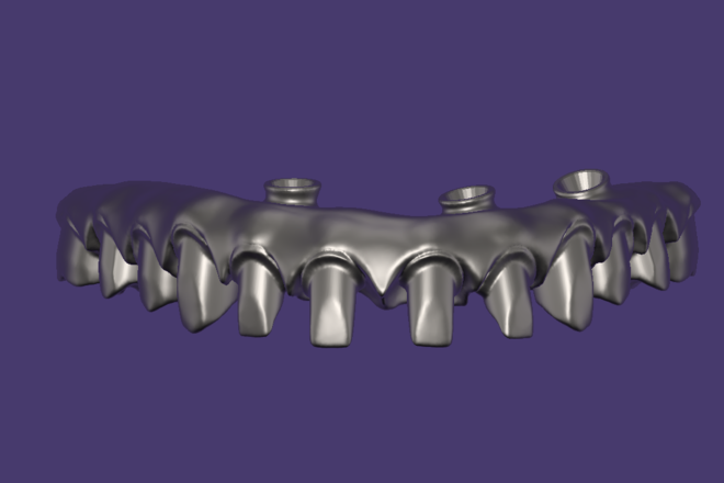 All on X - Full arch over implants