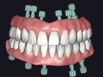 Dental Cad-Service: Dentro gengival