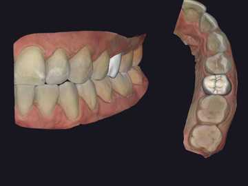 Dental Cad-Service: Crown on tooth / implant