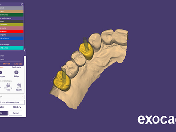 Serviço de Cad Dental: Implant Crown