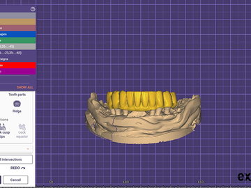 Serviço de Cad Dental: Implant bridge