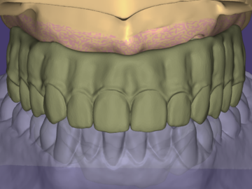 Dental Cad-Service: ALL ON X FULL ARCH OVER IMPLANT