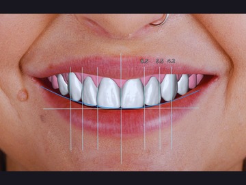 Serviço de Cad Dental: HIGH-LEVEL EXOCAD DESIGN 