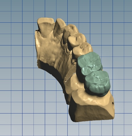 Crowns - CadCam Masters