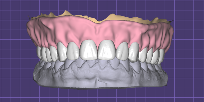 CAD Removable Denture Design - CadCam Masters