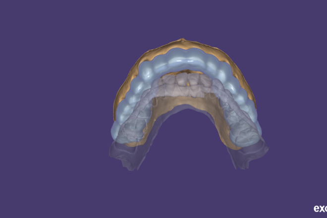 Bite Splints and Night Guards - CadCam Masters