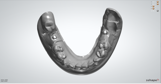 Dentes/Provisórios sob/Implantes - CadCam Masters