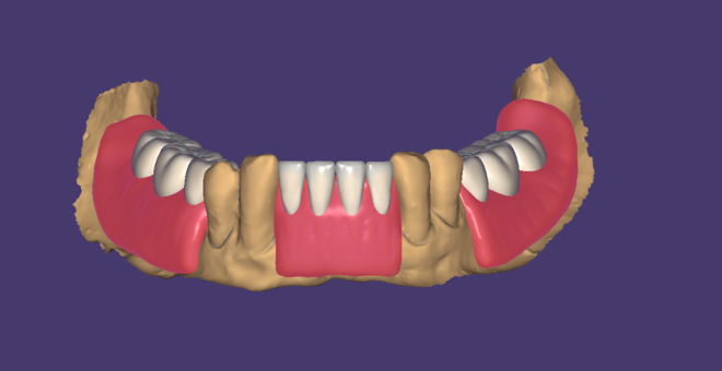 Removable partial denture - CadCam Masters