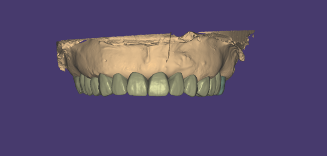 Crowns/Bridges & Inlay/onlay - CadCam Masters