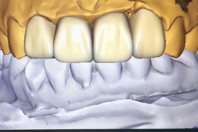 Crown - CadCam Masters