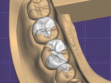Dental Cad Service: Inlays onlays, overlays, tabletops