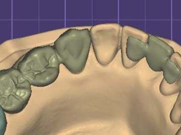 Dental Cad Service: Crowns, bridges