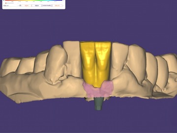 Service de Cad Dentaire: Crown & Implant crown
