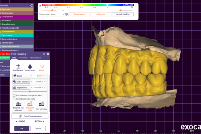 full arch immediate/longterm AOX prothesis - CadCam Masters