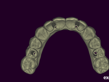 Dental Cad Service: full arch immediate/longterm AOX prothesis