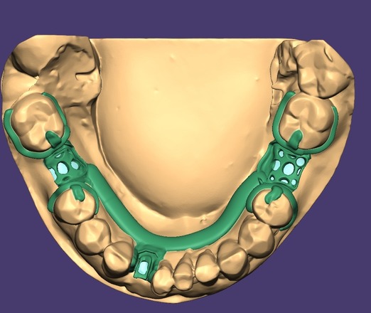 Metal Framework desing for RPD - CadCam Masters