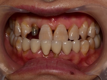 Service de Cad Dentaire: Crown & Implant crown