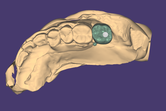 Implant crown - CadCam Masters