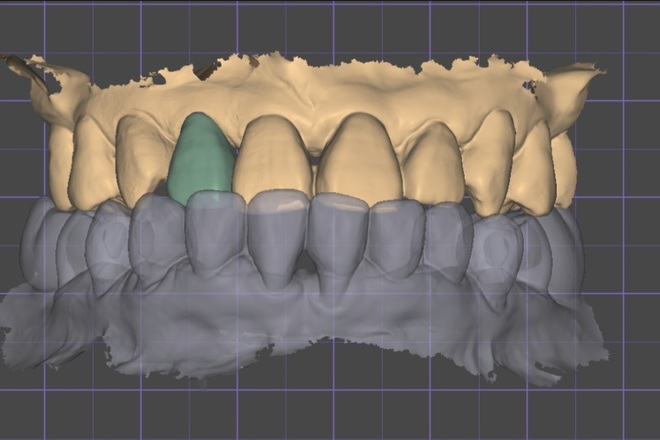 Full crown - CadCam Masters