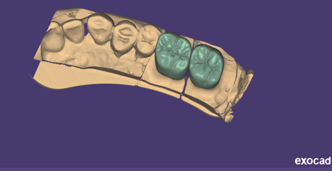 Crown Bridge - CadCam Masters