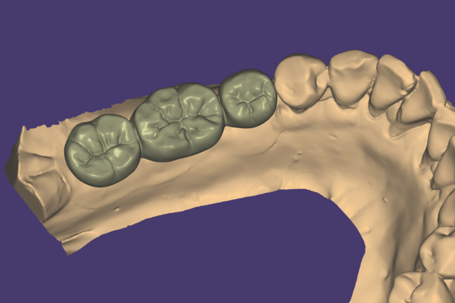 Full crown bridge - CadCam Masters