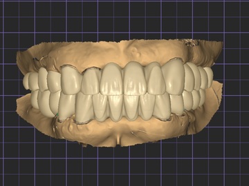 Dental Cad Service: Digital wax up