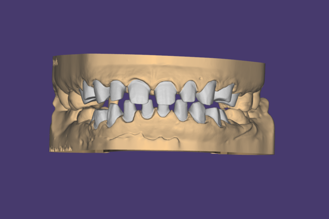 Crown Bridge - CadCam Masters