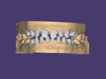 Dental Cad Service: Crown Bridge