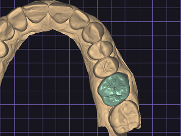 Dental Cad Service: Onlays & Inlays 